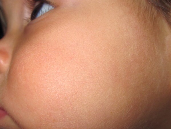 Using as a facial mask cures acne