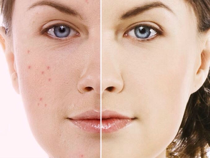 PIMPLES: Mix three tablespoons of honey and one teaspoon of cinnamon to make a powder paste. Apply this paste on the pimples before sleeping and wash it next morning with warm water. If done daily for two weeks, it removes pimples from the root.