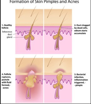 Natural treatments for pimples are highly effective and less likely to cause irritation or other adverse reactions.