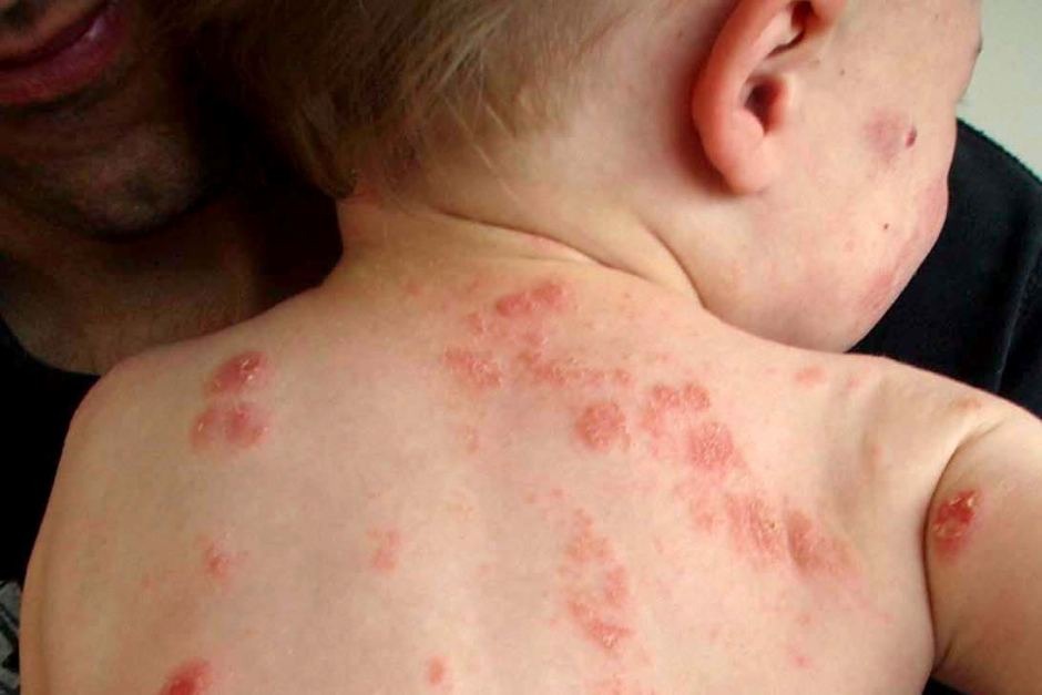 DIY Psoriasis,eczema And Skin Discoloration Cream #tip It