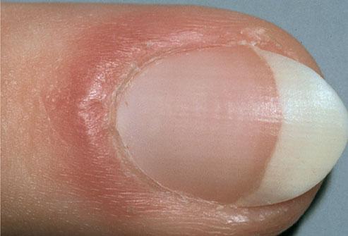 Puffy Nail Fold
If the skin around the nail appears red and puffy, this is known as inflammation of the nail fold. It may be the result of lupus or another connective tissue disorder. Infection can also cause redness and inflammation of the nail fold