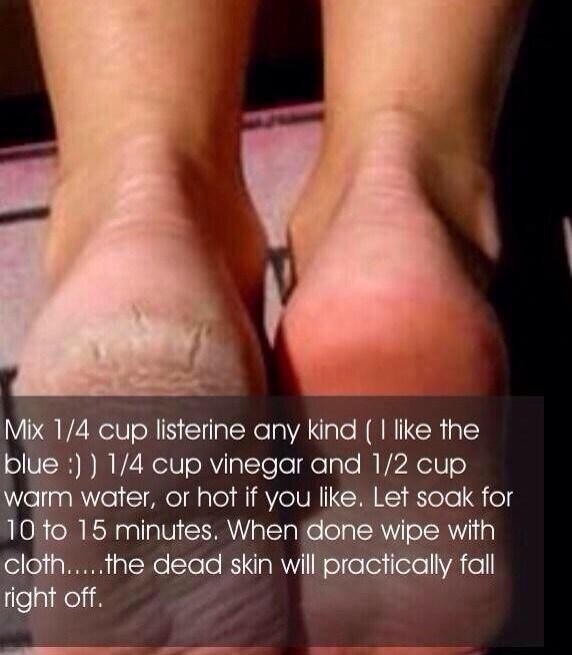 12. Easy remedy for your cracked soles.