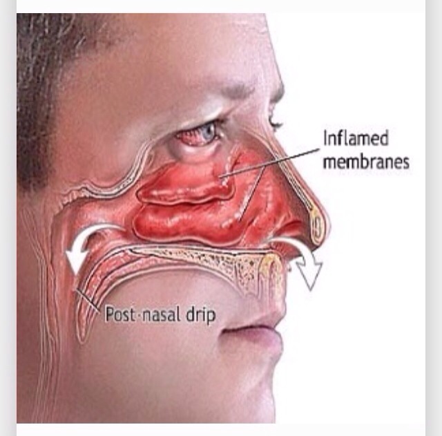 Top Natural Remedies For Sinus Congestion You Can Make at Home!