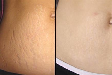 Home Remedies to Get Rid of Stretch Marks Naturally
Most products and treatments can be costly. And that is exactly why we are recommending you some home remedies to remove stretch marks naturally: