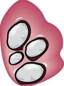 8. Kidney stones

Low fluid intake and dehydration are major risk factors for kidney stones. Drinking enough water is a key to kidney health.