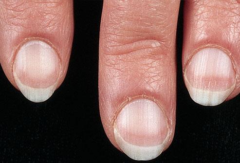Pale Nails
Very pale nails can sometimes be a sign of serious illness, such as:
Anemia
Congestive heart failure
Liver disease
Malnutrition
