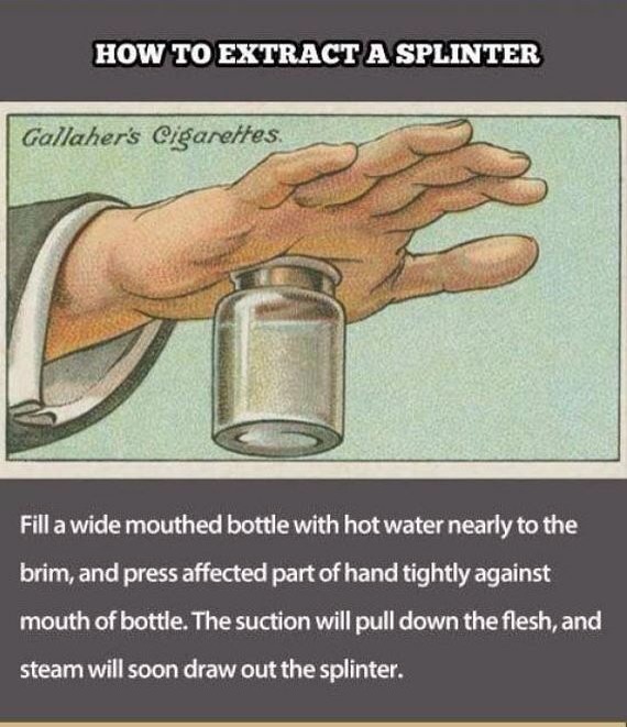 #3 splinter removal 