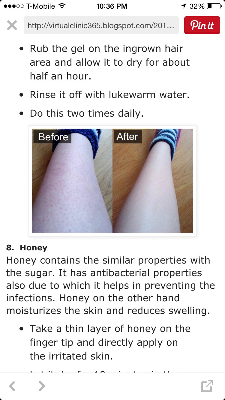 How To Get Rid Of Ingrown Hair! 