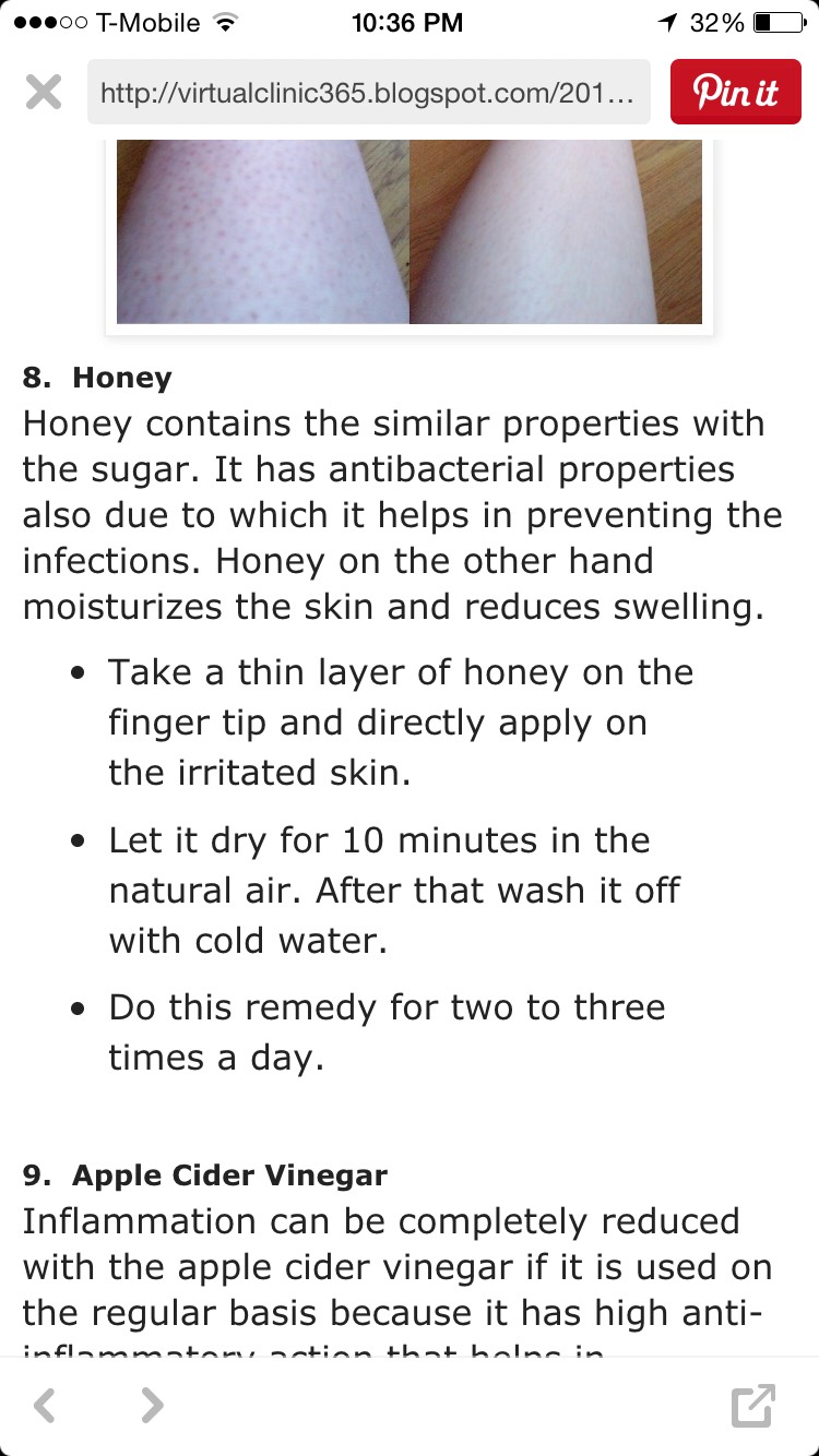 How To Get Rid Of Ingrown Hair! 