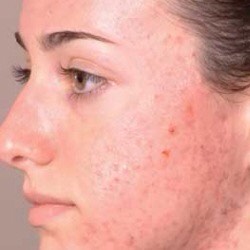 Get Rid Of Acne Fast❤️