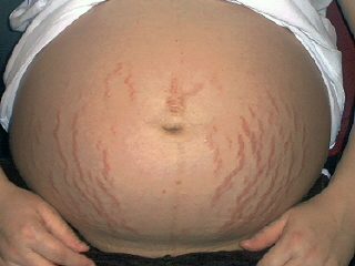 Apply some baby oil to soften skin and prevent streach marks while pregnant .