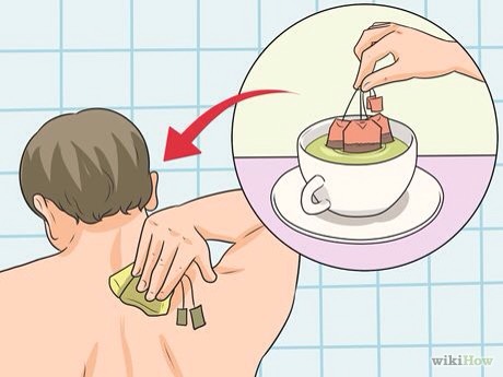 How To Get Rid Of Sunburn Overnight #greengoddess