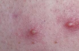 Pustules

Pustules are often thought of as the stereotypical spot or zit. Closest to the surface of the skin, they are red and can often be described as “angry looking”. As the lesion moves outwards from the skin, a prominent head forms often white or yellow in colour.