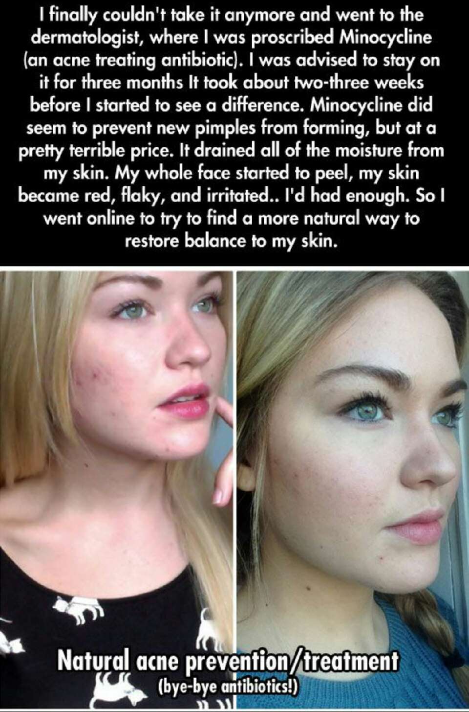 Natural Acne Prevention/ Treatment, bye bye Antibiotics! 
