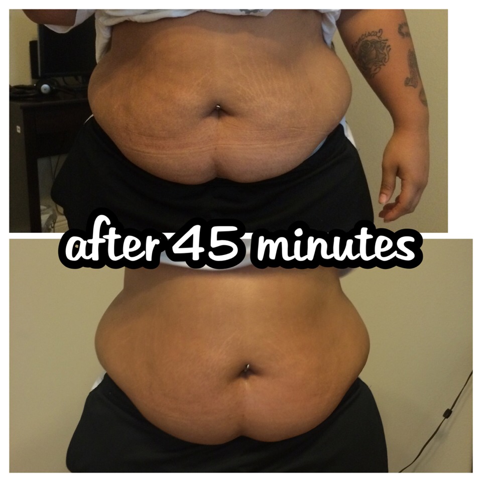 You see the drastic reduction of her stretch marks and cellulite, with just one application after 45 minutes.
