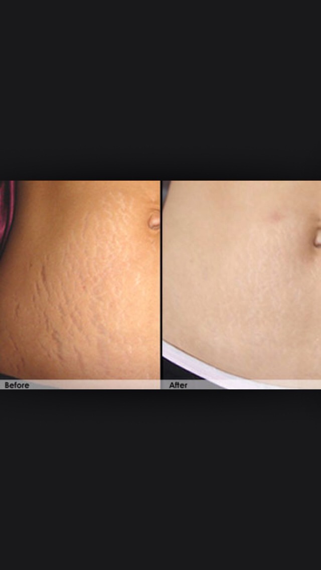 Use cocoa butter to fade away stretch marks 🍃🍂