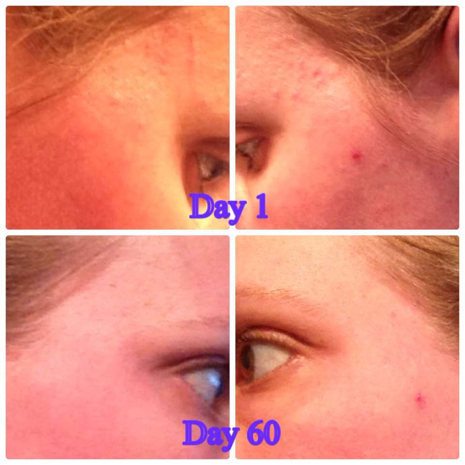 This is me!! I have suffered from acne all my life (since preteen, now 35); but using Unblemish for 60 days I have clear skin for the first time ever!!! (The red "spot" on the left side of my face is from when I was pregnant with my first child; I wanted to clarify that. Lol)