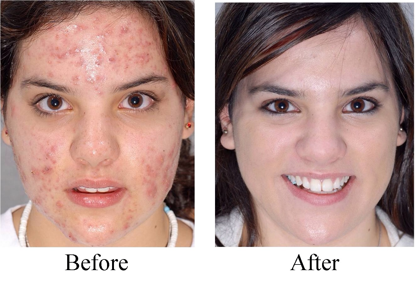 Have acne? Take a cotton ball and soak it in listerine and dab it on your acne!