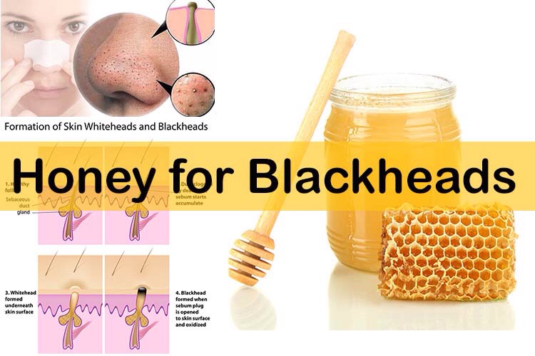 GET RID OF BLACKHEADS IN 3 MINUTES