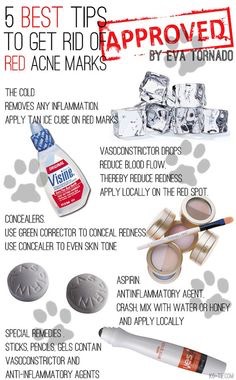 Best Tips To Get Rid Of Acne Marks