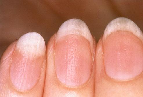 Rippled Nails
If the nail surface is rippled or pitted, this may be an early sign of psoriasis or inflammatory arthritis. Discoloration of the nail is common; the skin under the nail can seem reddish-brown.