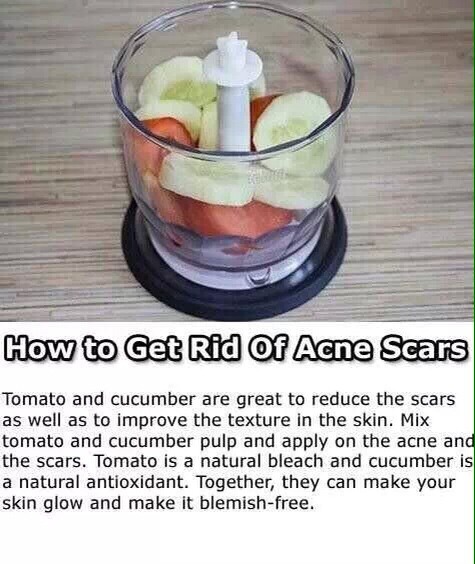 How To get Rid Of Acne Scars..the Natural Way