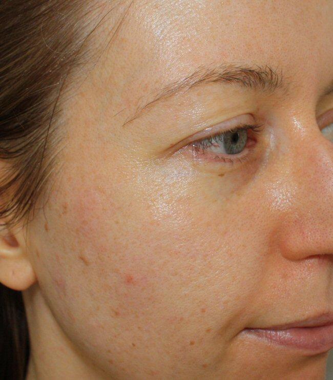 Cheeks. Your cheeks are linked to your respiratory system. Smoking or breathing polluted air can cause breakouts here