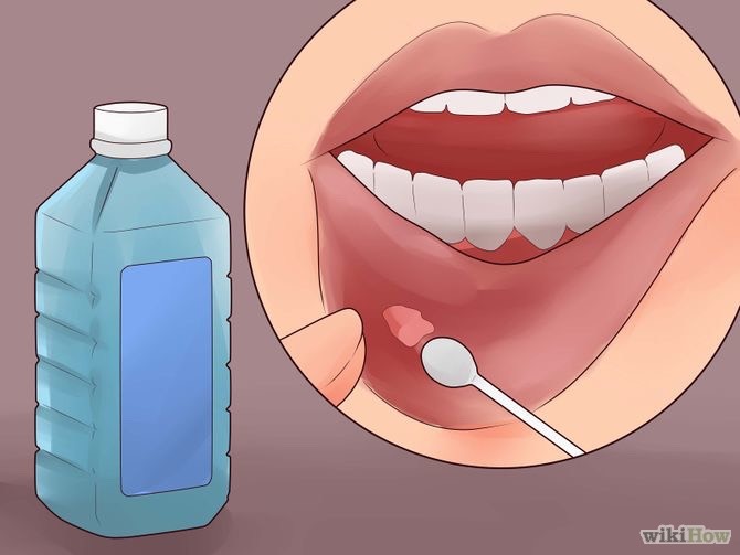 Dip Hydrogen peroxide on a q-tip and place it on the ulcers 3 times a day