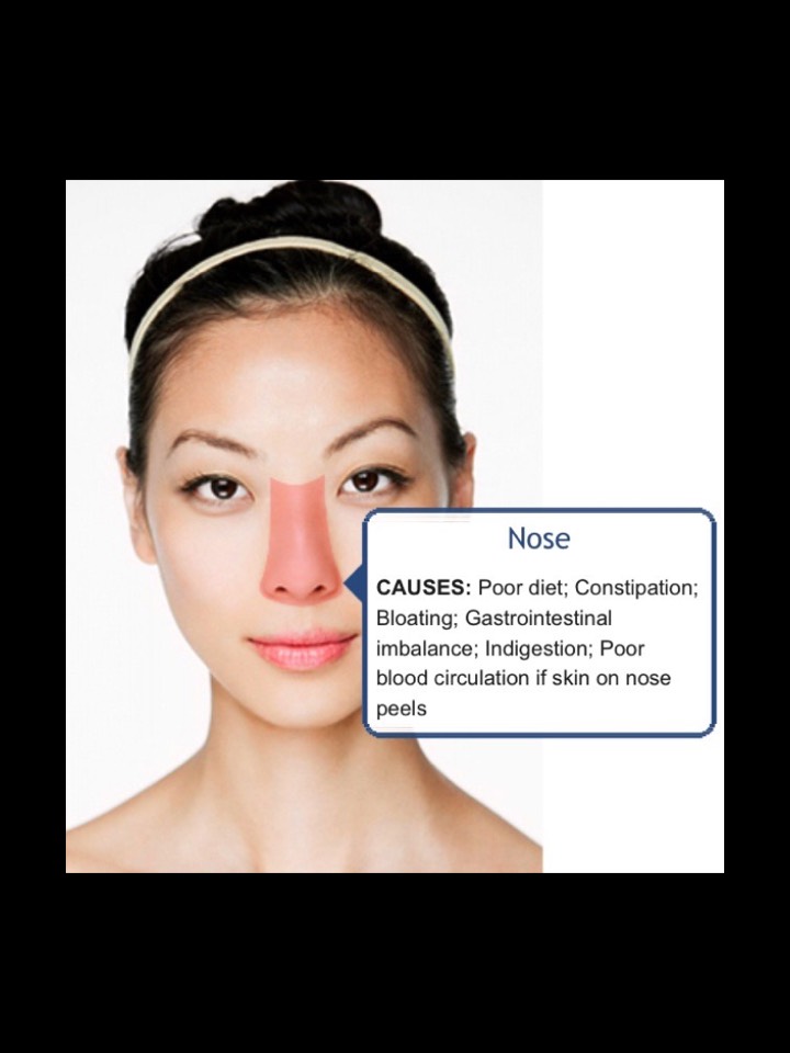 Face Mapping-What Your Acne Telling You? 😱👍👍