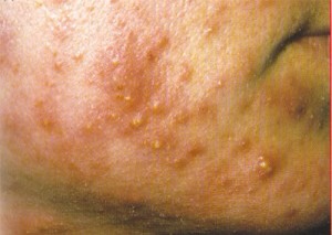 Papules

Papules differ slightly from other types of acne spots in that they do not contain any puss. They are inflamed red spots incurred from the excess sebum and they are raised up from the skin.