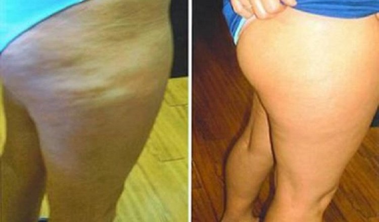 HOW TO GET RID OF CELLULITE USING CINNAMON