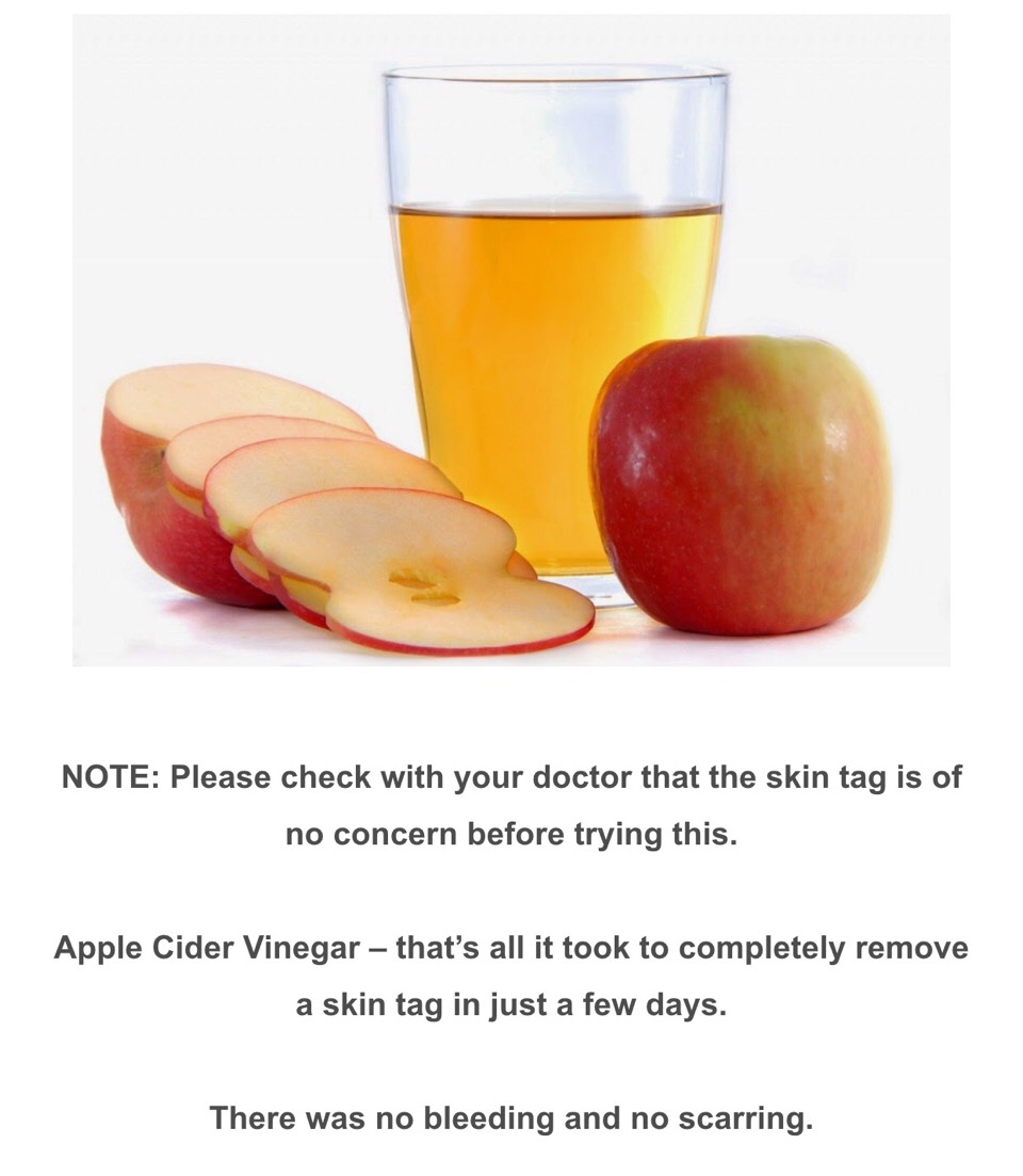 How To Remove Skin Tags With One Simple Ingredient. 😊