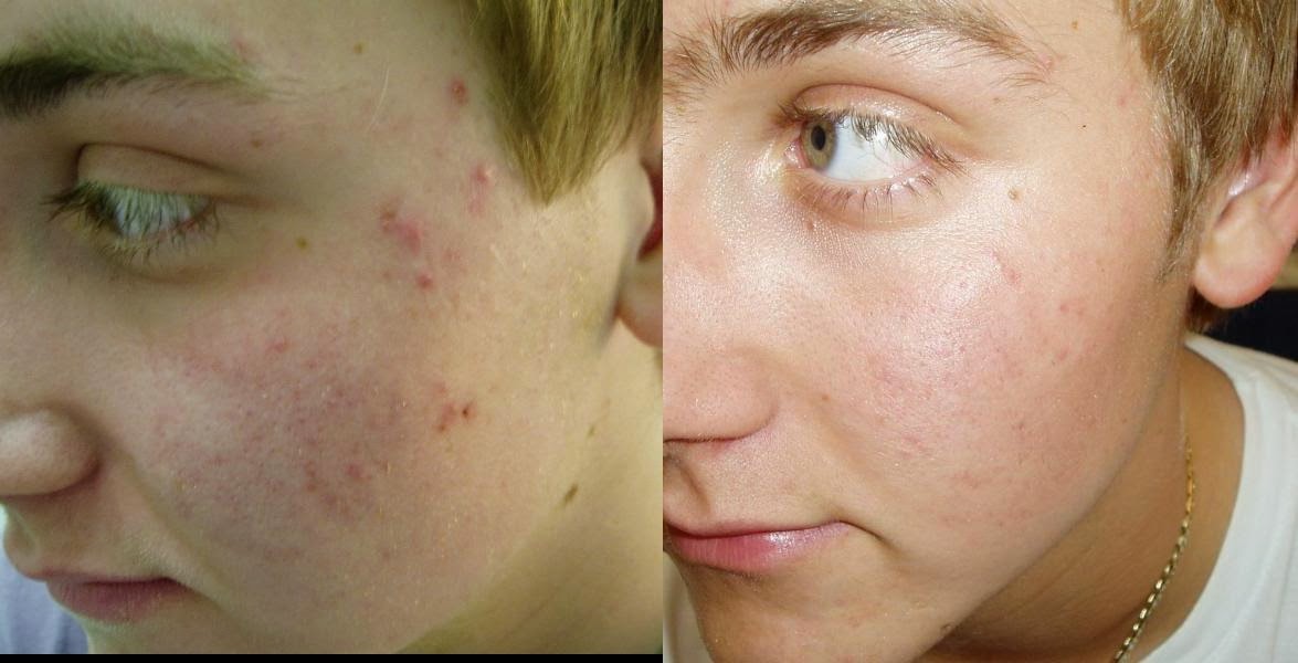Tired Of Pimple Use Lemon Before Go Sleep Half Lemon In Your Face Swipe It And In One Week Results