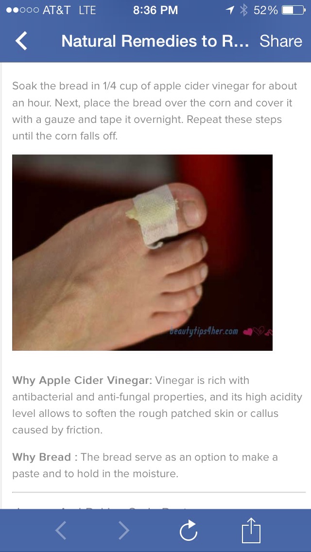 Natural Remedies to Remove Corn and Calluses – This Really Works
