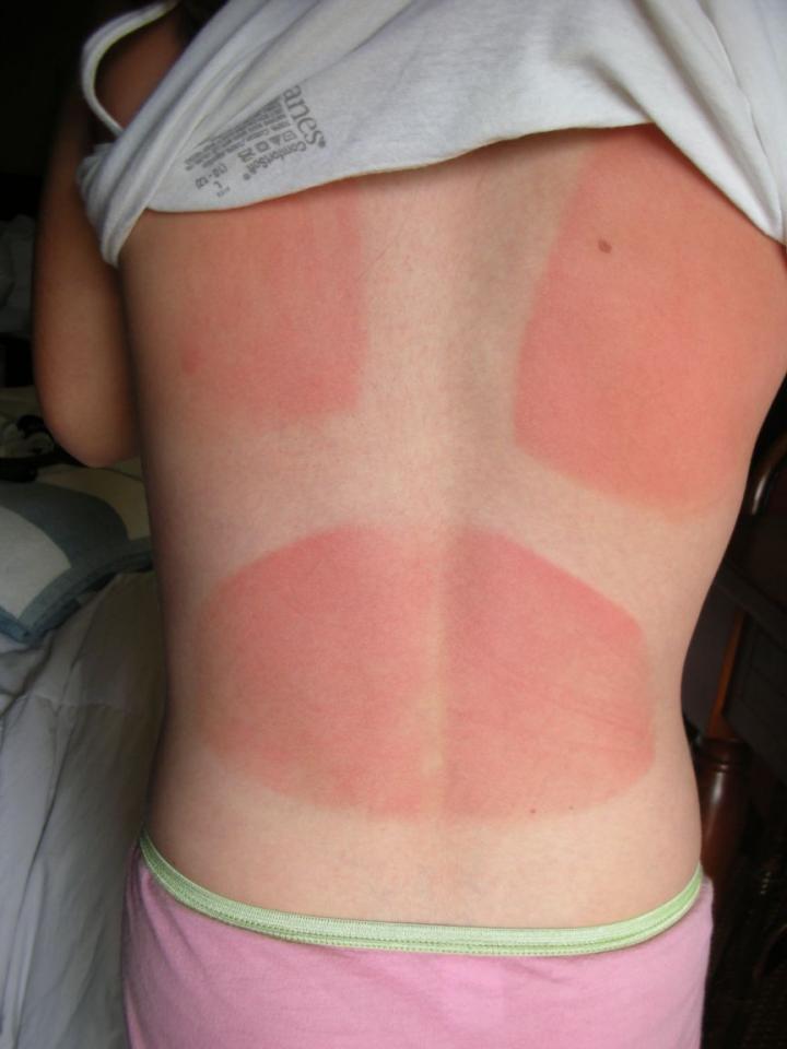 Relieving Sunburns
Apply the oil after you’ve overdone it on the sun exposure to soothe your skin.