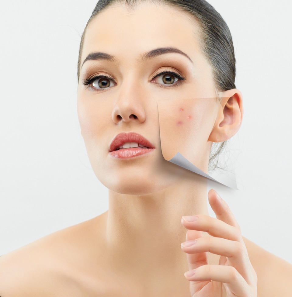 3. Stop picking skin in spot and acne areas: 
Many people see that the skin picking habit is tempting and it is really hard for them to ignore the scars and spots. In fact, picking at the spots or scars can interrupt the healing process that by which your skin heals and recovers itself