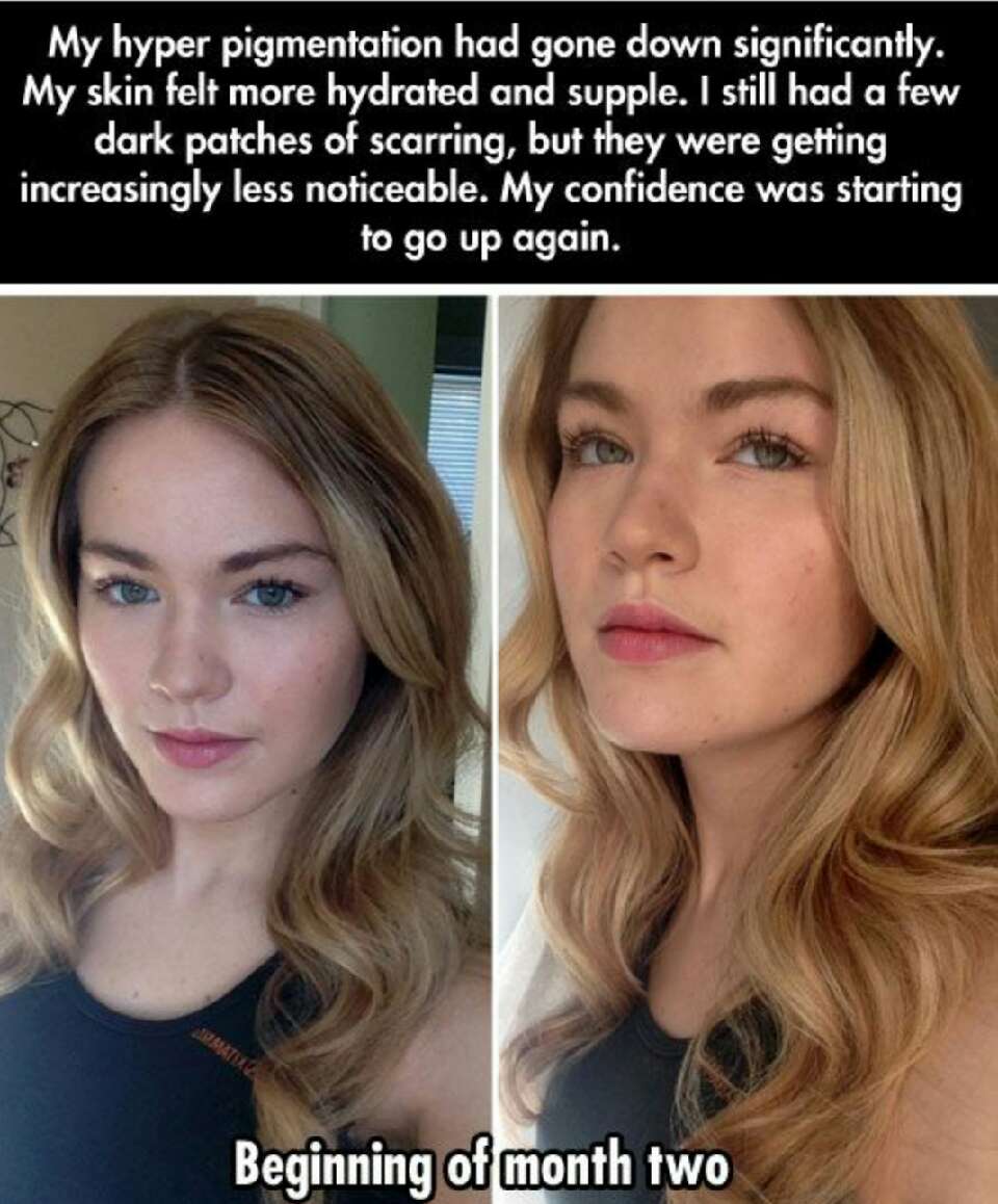 Natural Acne Prevention/ Treatment, bye bye Antibiotics! 