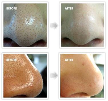 GET RID OF BLACKHEADS IN 3 MINUTES