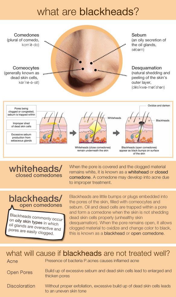 1. Before you do anything, it’s important to know exactly what blackheads are.