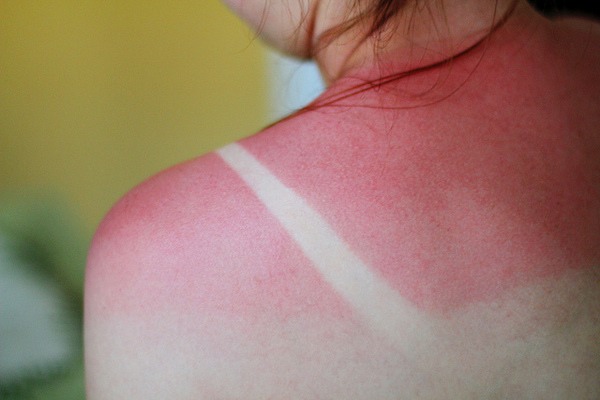 just apply vaseline on the sunburn area, it will help lock in the moisture and also ur dried out skin also prevent peeling! 