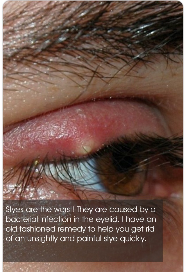 " Homemade Remedy To Get Rid Of Styes"
