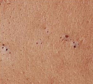 Blackheads

They occur when there is a larger opening in the pore and dead skin cells form a partial blockage causing the skins natural oil (Sebum) to build up beneath the surface.