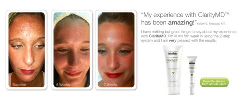How To get Rid Of Acne Scars..the Natural Way