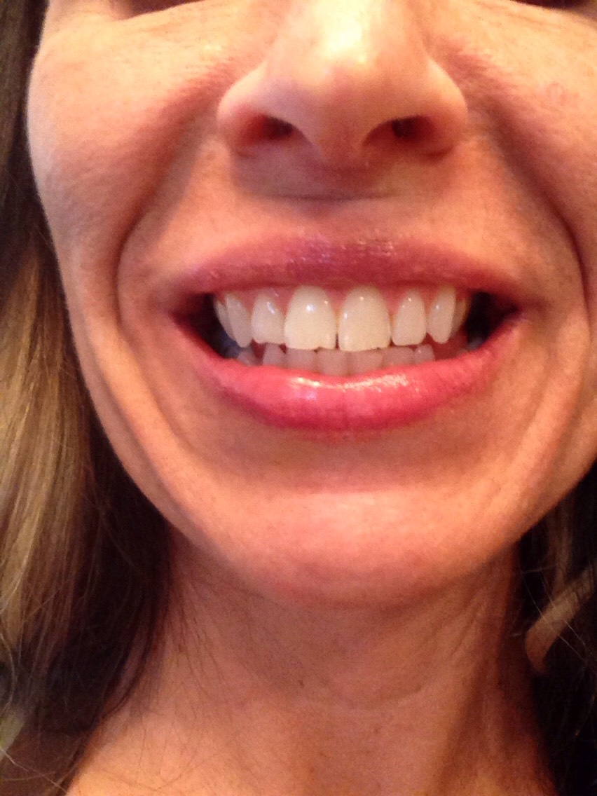 Teeth will be whiter. Do this everyday for a week and you will see a huge difference! I love it! And don't worry if you shallow some because both Tumeric and Coconut Oil are good for you and have cancer fighting ingredients :)