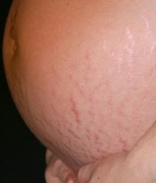 Getting Dark Stretch Marks To Fade