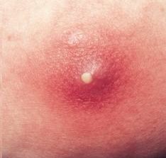 Cysts
Cysts appear similar to acne nodules, however they are filled with pus and are very painful. Never try to pop or squeeze  cysts since it can lead to deeper infection and serious inflammation which will last for months.