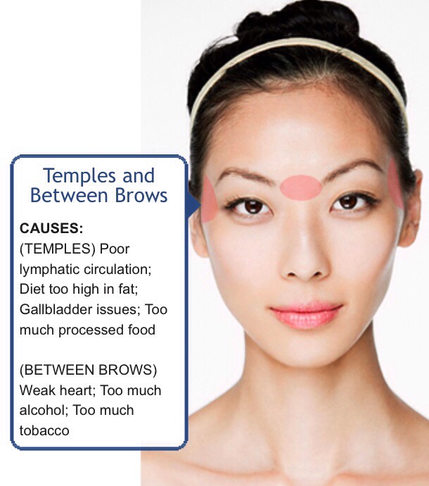Face Mapping (Acne) - What Is Your Acne Telling You? 