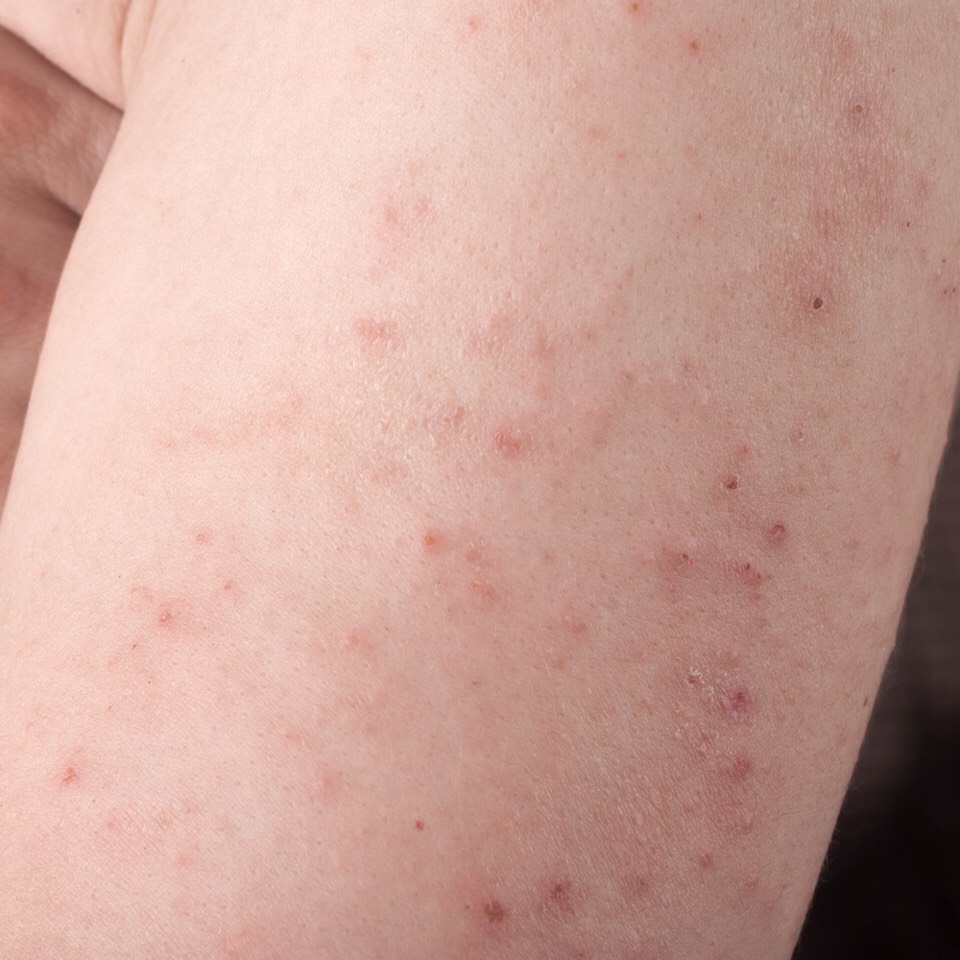 SKIN INFECTIONS: Apply honey and cinnamon powder in equal parts on the affected parts to cure eczema, ringworm and all types of skin infections