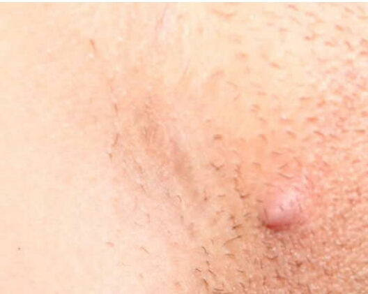 GETRID OF IN GROWN HAIRS LIKE RAZOR BUMPS OR SKIN PIMPLE 