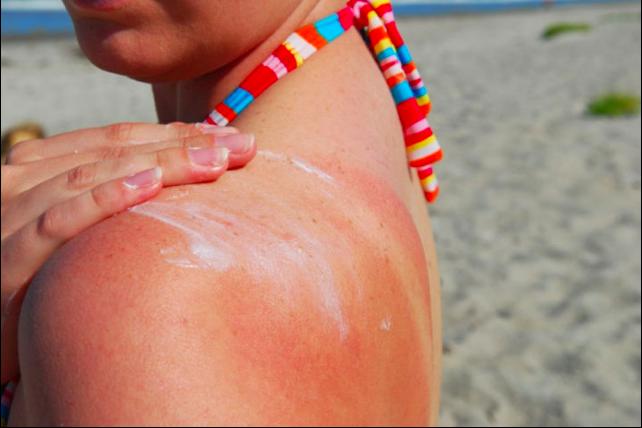 2. Sunburn relief
Epsom salt’s anti-inflammatory properties make it a great tool for alleviating mild sunburn irritation. Take an empty spray bottle, mix two tablespoons of Epsom with one cup of water and spray on the affected area. Your days of dealing with messy aloe are over!